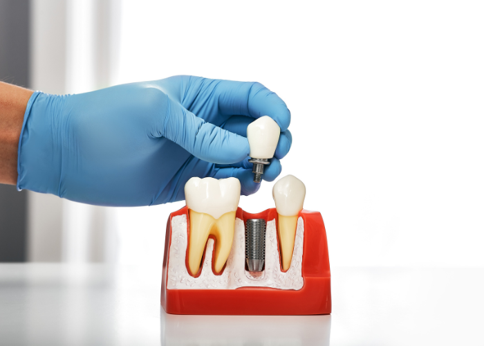 Dental Implants Fayetteville, GA