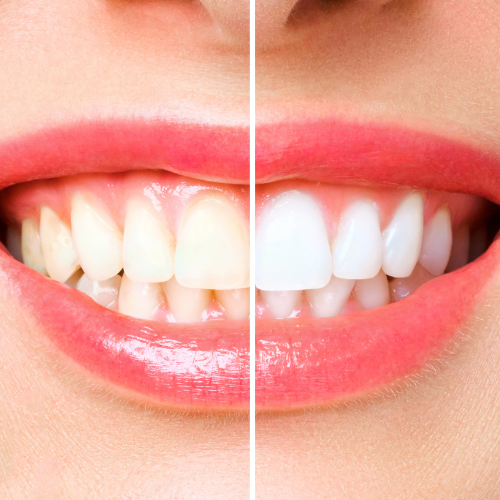 1 Teeth Whitening in Fayetteville, GA