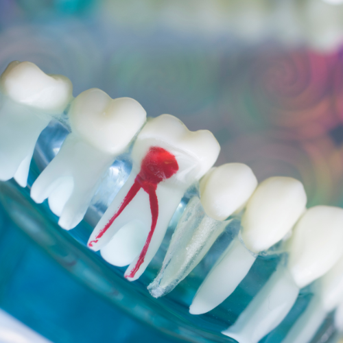 8 Root Canal Therapy in Fayetteville, GA