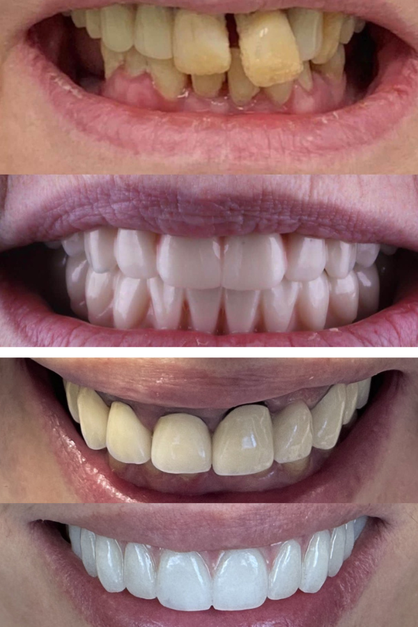 Dental Implants Fayetteville before after Dental Implants Fayetteville before after